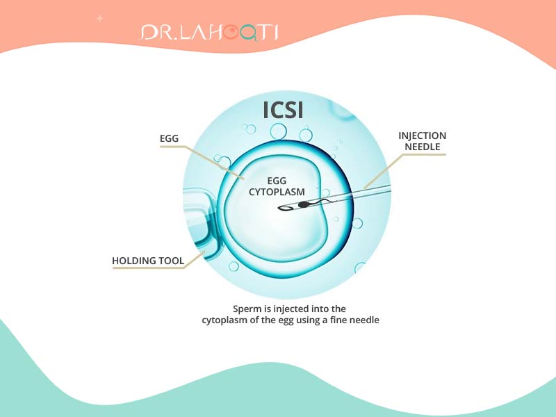 آی وی اف با میکرو اینجکشن | IVF | ICSI | Sperm