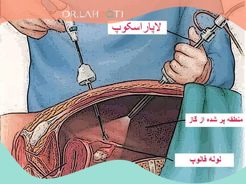 لاپاروسکوپی | Laparoscopy