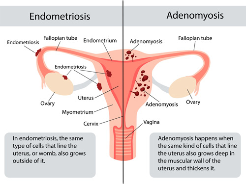 تفاومت آدنو میوز و آندو متریوز | Adenomyosis vs Endometriosis
