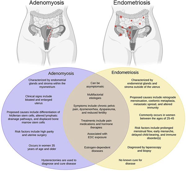 تفاومت آدنومیوز و آندومتریوز | Adenomyosis vs Endometriosis