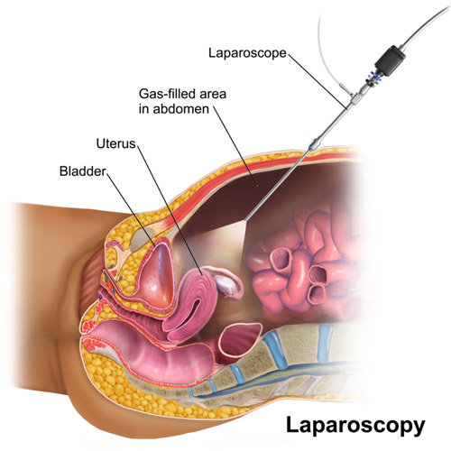 لاپاراتومی | لاپاروتومی | Laparotomy | لاپاروسکوپی