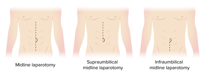 لاپاراتومی | لاپاروتومی | Laparotomy