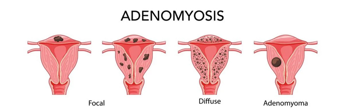 آدنومیوز | ادنومیوز | Adenomyosis