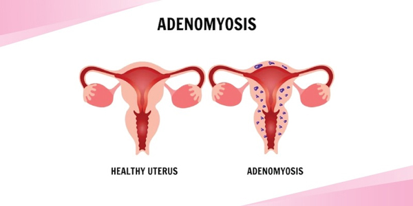 آدنومیوز | ادنومیوز | Adenomyosis