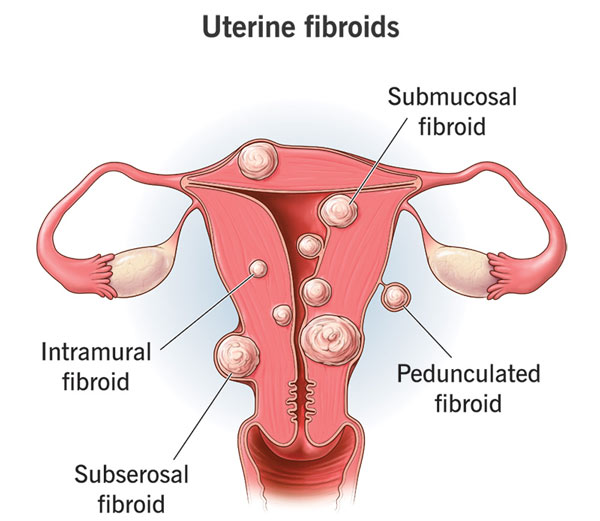 فیبروم رحم | Uterine fibroids