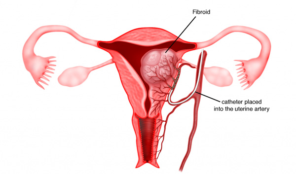 فیبروم رحم | Uterine fibroids