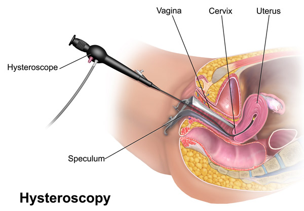 هیستروسکوپی | hysteroscopy