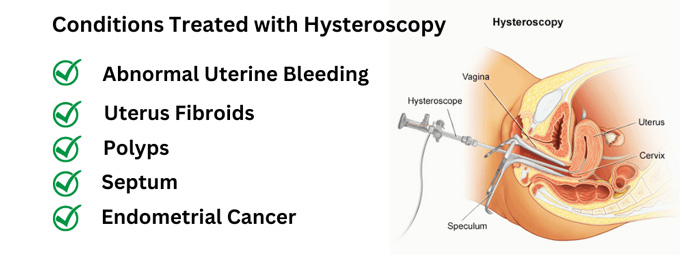 هیستروسکوپی | hysteroscopy