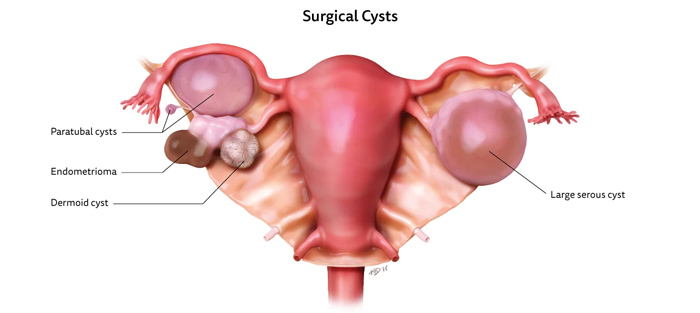 انواع کیست | باروری | Ovarian Cyst