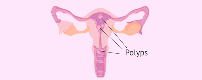 پولیپ رحم | uterine polyp
