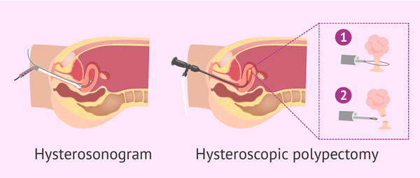پولیپ رحم | uterine polyp