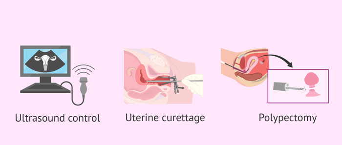 درمان پولیپ رحم | uterine polyp