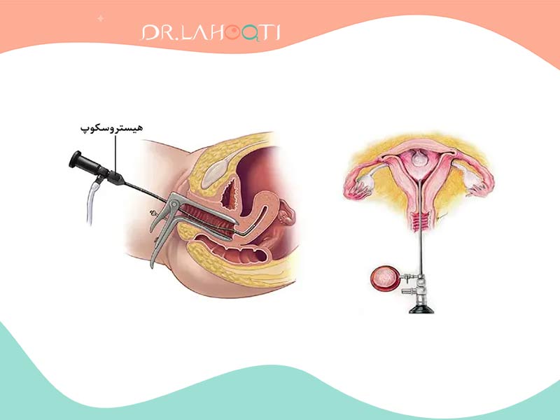 هیستروسکوپی | hysteroscopy