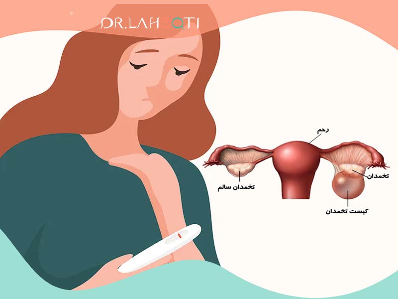 کیست تخمدان | باروری | Ovarian Cyst