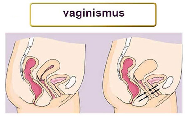 واژینیسموس | Vaginismus
