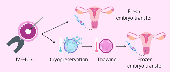 فریز جنین حاصل از آی وی اف IVF | انجماد جنین | Embryo Freezing